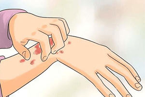 慢性荨麻疹患者要如何护理